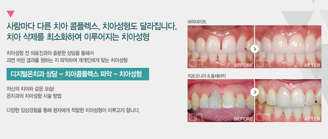 치아성형전후